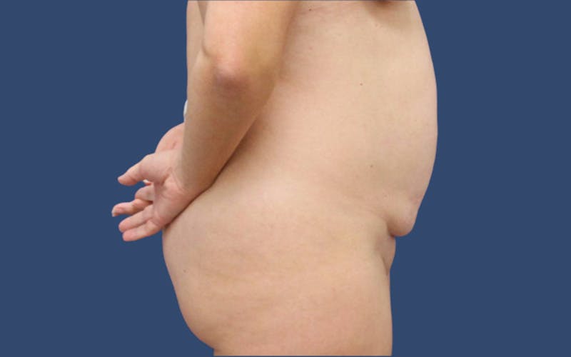 Mommy Makeover Before & After Gallery - Patient 296010 - Image 3