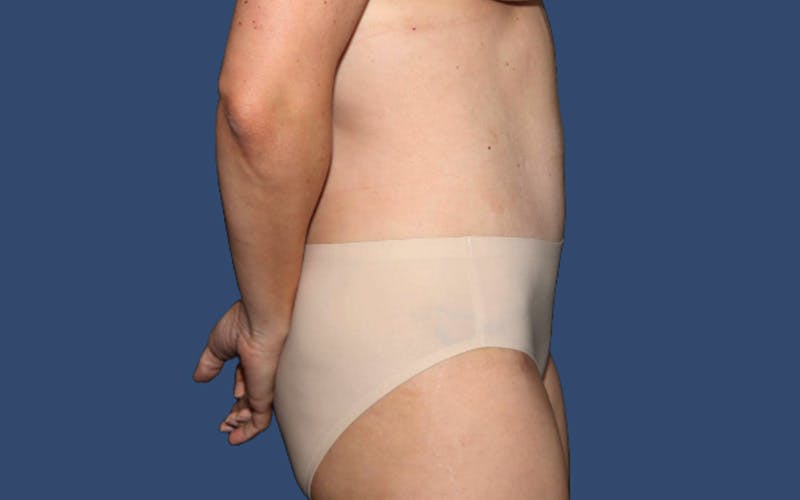 Mommy Makeover Before & After Gallery - Patient 296010 - Image 4