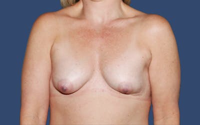 Breast Revision Before & After Gallery - Patient 889702 - Image 1