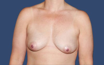 Breast Revision Before & After Gallery - Patient 889702 - Image 2