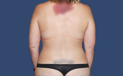 Liposuction Before & After Gallery - Patient 341748 - Image 1