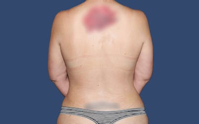 Liposuction Before & After Gallery - Patient 341748 - Image 2