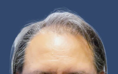 Male Hair Transplant Before & After Gallery - Patient 216338 - Image 1
