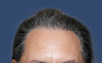 Male Hair Transplant Before & After Gallery - Patient 216338 - Image 2