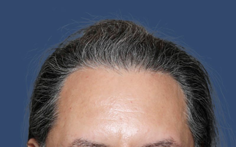 Male Hair Transplant Before & After Gallery - Patient 216338 - Image 2