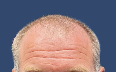 Male Hair Transplant Before & After Gallery - Patient 277989 - Image 1