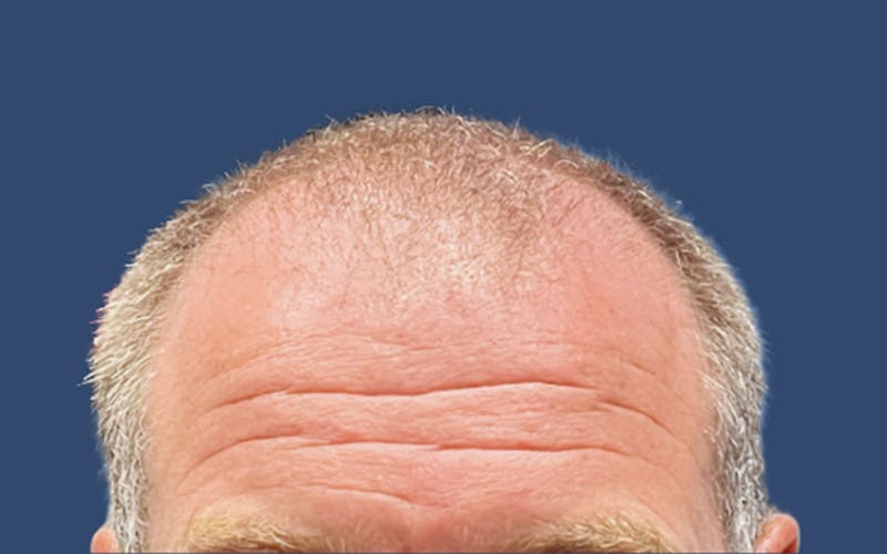 Hair Transplant in San Antonio Before & Afters Photos