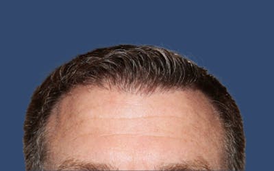 Male Hair Transplant Before & After Gallery - Patient 277989 - Image 2