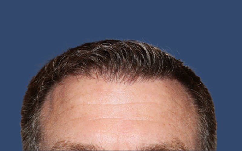 Hair Transplant in San Antonio Before & Afters Photos