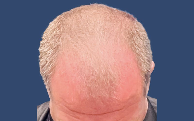 Male Hair Transplant Before & After Gallery - Patient 277989 - Image 3