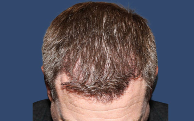 Male Hair Transplant Before & After Gallery - Patient 277989 - Image 4