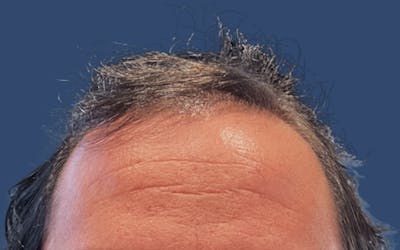 Male Hair Transplant Before & After Gallery - Patient 420145 - Image 1
