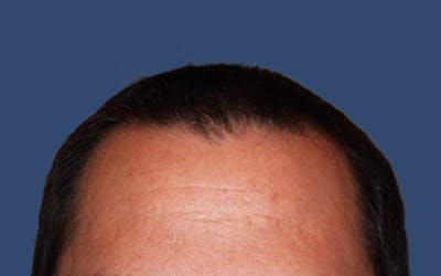 Male Hair Transplant Before & After Gallery - Patient 420145 - Image 2