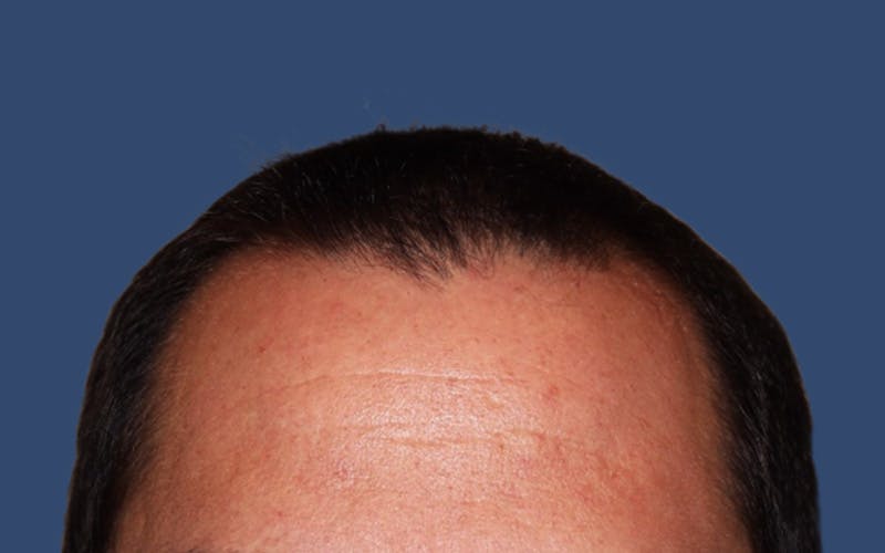 Male Hair Transplant Before & After Gallery - Patient 420145 - Image 2