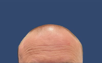 Male Hair Transplant Before & After Gallery - Patient 327403 - Image 1