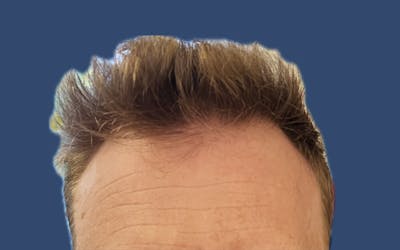 Male Hair Transplant Before & After Gallery - Patient 327403 - Image 2