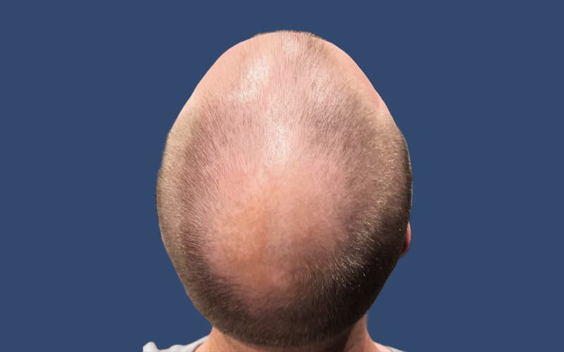 Male Hair Transplant Before & After Gallery - Patient 327403 - Image 3