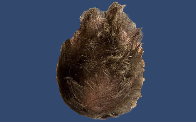 Male Hair Transplant Before & After Gallery - Patient 327403 - Image 4