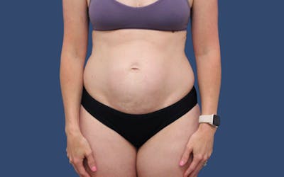 Tummy Tuck Before & After Gallery - Patient 113189 - Image 1