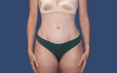Tummy Tuck Before & After Gallery - Patient 113189 - Image 2
