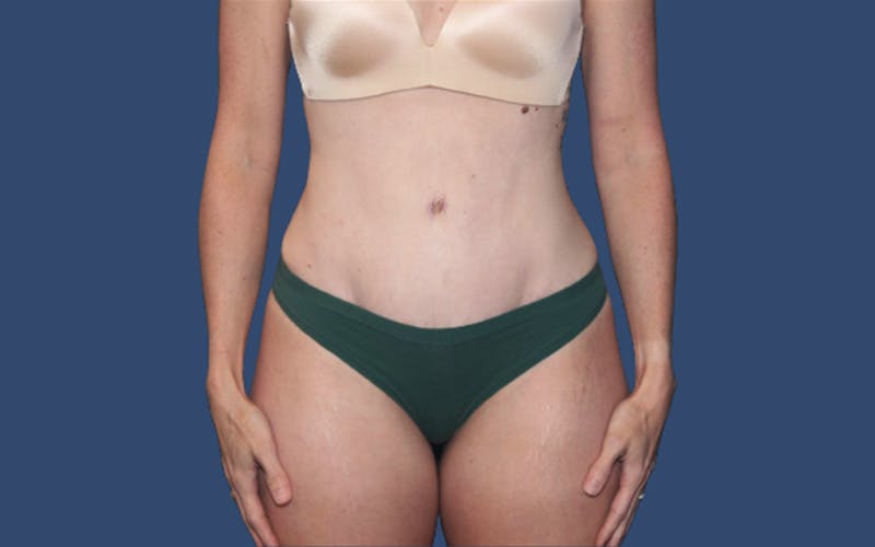 Tummy Tuck Before & After Gallery - Patient 113189 - Image 2