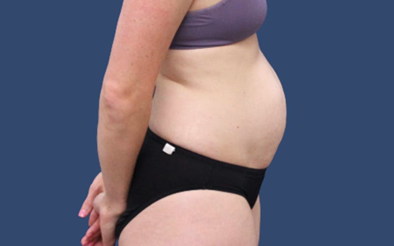 Tummy Tuck Before & After Gallery - Patient 113189 - Image 3