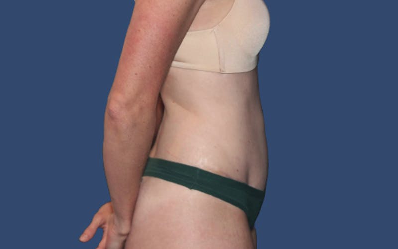 Tummy Tuck Before & After Gallery - Patient 113189 - Image 4
