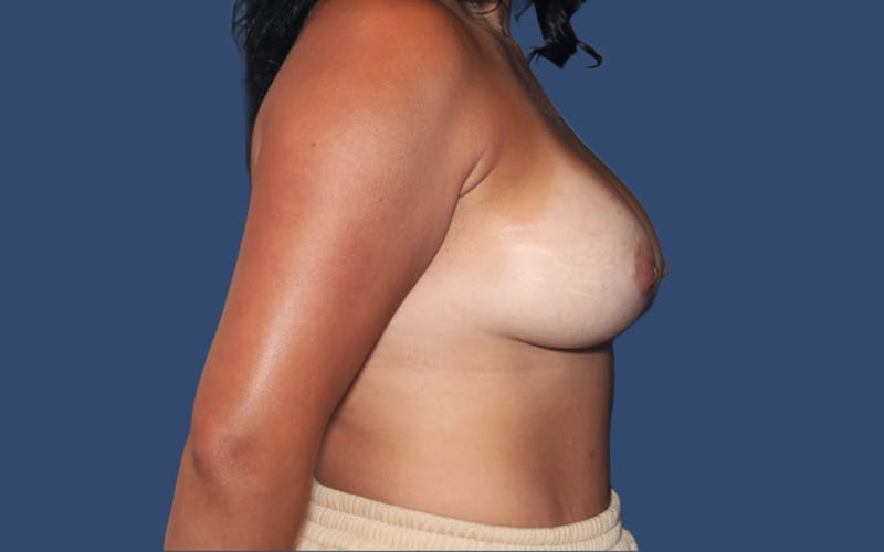 Breast Augmentation Before & After Gallery - Patient 370665 - Image 4