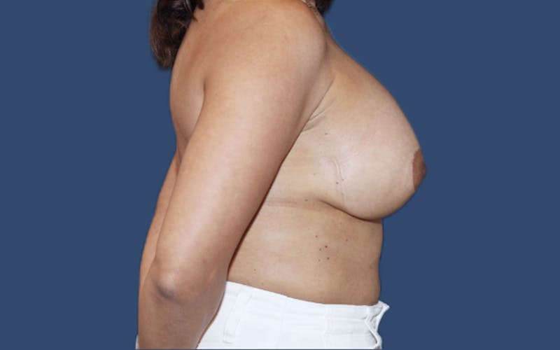Breast Lift with Augmentation Before & After Gallery - Patient 121288 - Image 4