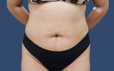 Tummy Tuck Before & After Gallery - Patient 212978 - Image 1