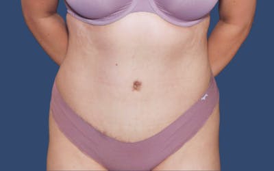 Tummy Tuck Before & After Gallery - Patient 212978 - Image 2