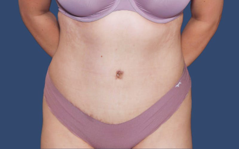 Tummy Tuck Before & After Gallery - Patient 212978 - Image 2