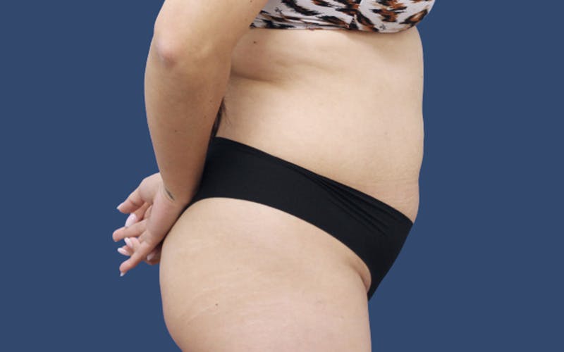 Tummy Tuck Before & After Gallery - Patient 212978 - Image 3