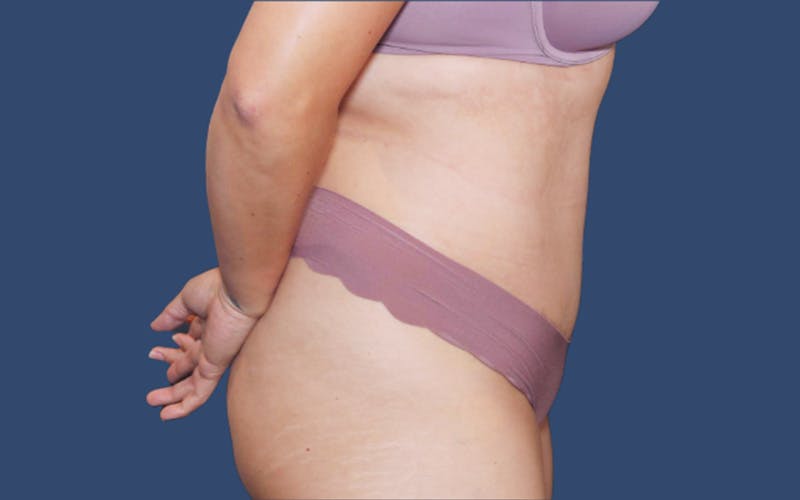 Tummy Tuck Before & After Gallery - Patient 212978 - Image 4