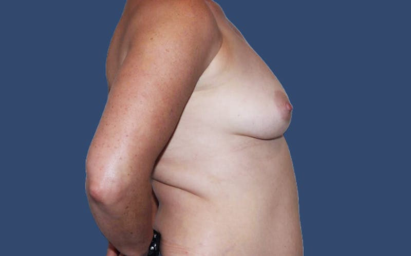 Breast Augmentation Before & After Gallery - Patient 294142 - Image 3