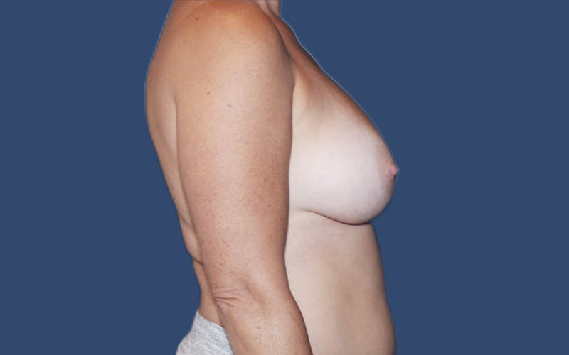 Breast Augmentation Before & After Gallery - Patient 294142 - Image 4