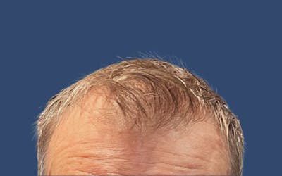 Male Hair Transplant Before & After Gallery - Patient 103928 - Image 1
