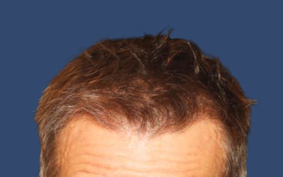 Male Hair Transplant Before & After Gallery - Patient 103928 - Image 2