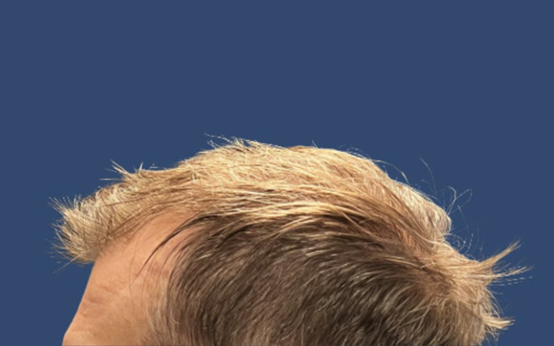 Male Hair Transplant Before & After Gallery - Patient 103928 - Image 3