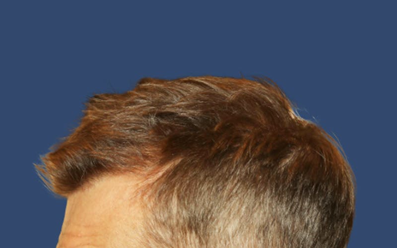Male Hair Transplant Before & After Gallery - Patient 103928 - Image 4