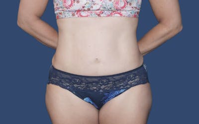 Tummy Tuck Before & After Gallery - Patient 302685 - Image 2