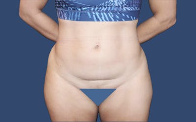 Tummy Tuck Before & After Gallery - Patient 302685 - Image 1