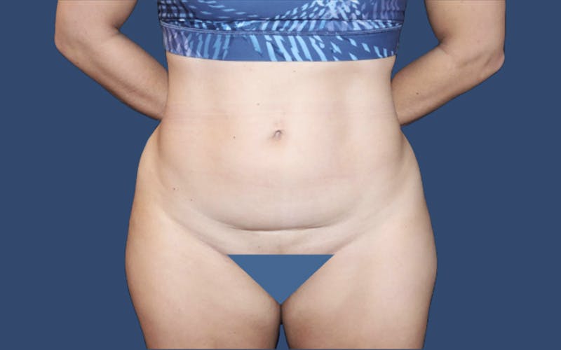 Tummy Tuck Before & After Gallery - Patient 302685 - Image 1