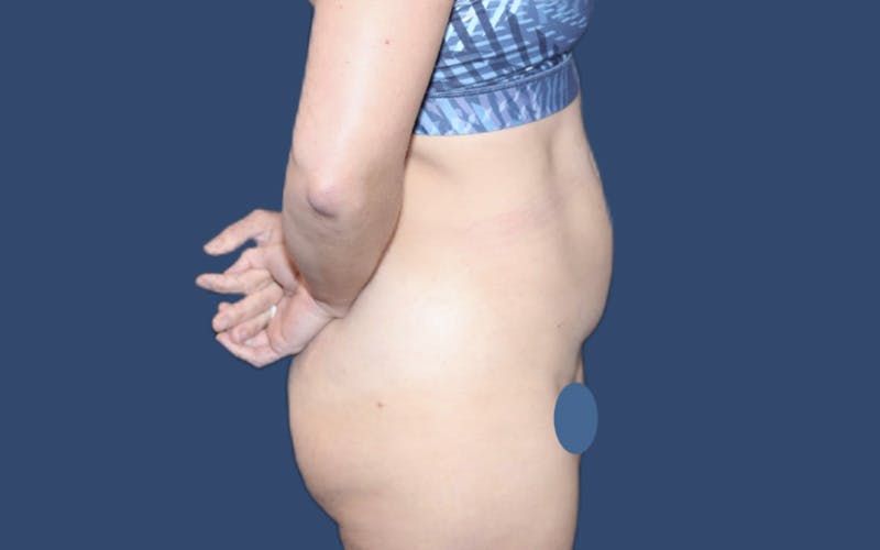 Tummy Tuck Before & After Gallery - Patient 302685 - Image 3
