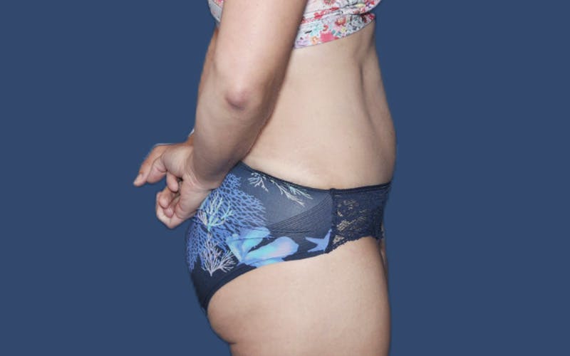 Tummy Tuck Before & After Gallery - Patient 302685 - Image 4