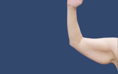 Arm Lift Before & After Gallery - Patient 328375 - Image 1