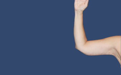 Arm Lift Before & After Gallery - Patient 328375 - Image 2