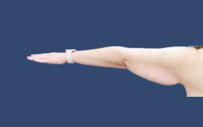 Arm Lift Before & After Gallery - Patient 328375 - Image 1