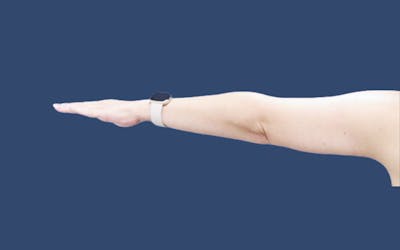 Arm Lift Before & After Gallery - Patient 328375 - Image 2