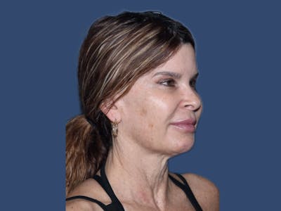 Neck Lift Before & After Gallery - Patient 309901 - Image 1